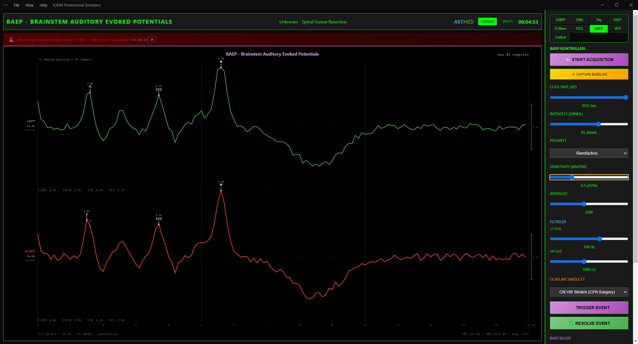 BAEP Beyin Sapı İşitsel Evoke Potansiyel