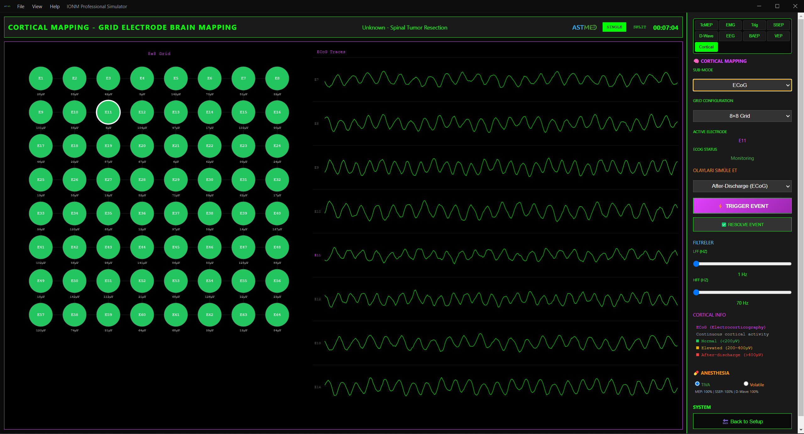 Kortikal Haritalama 8×8 ECoG Grid