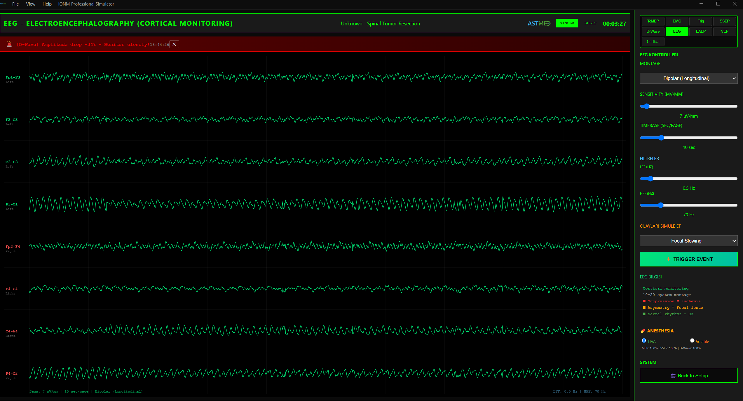EEG Kortikal Monitorizasyon