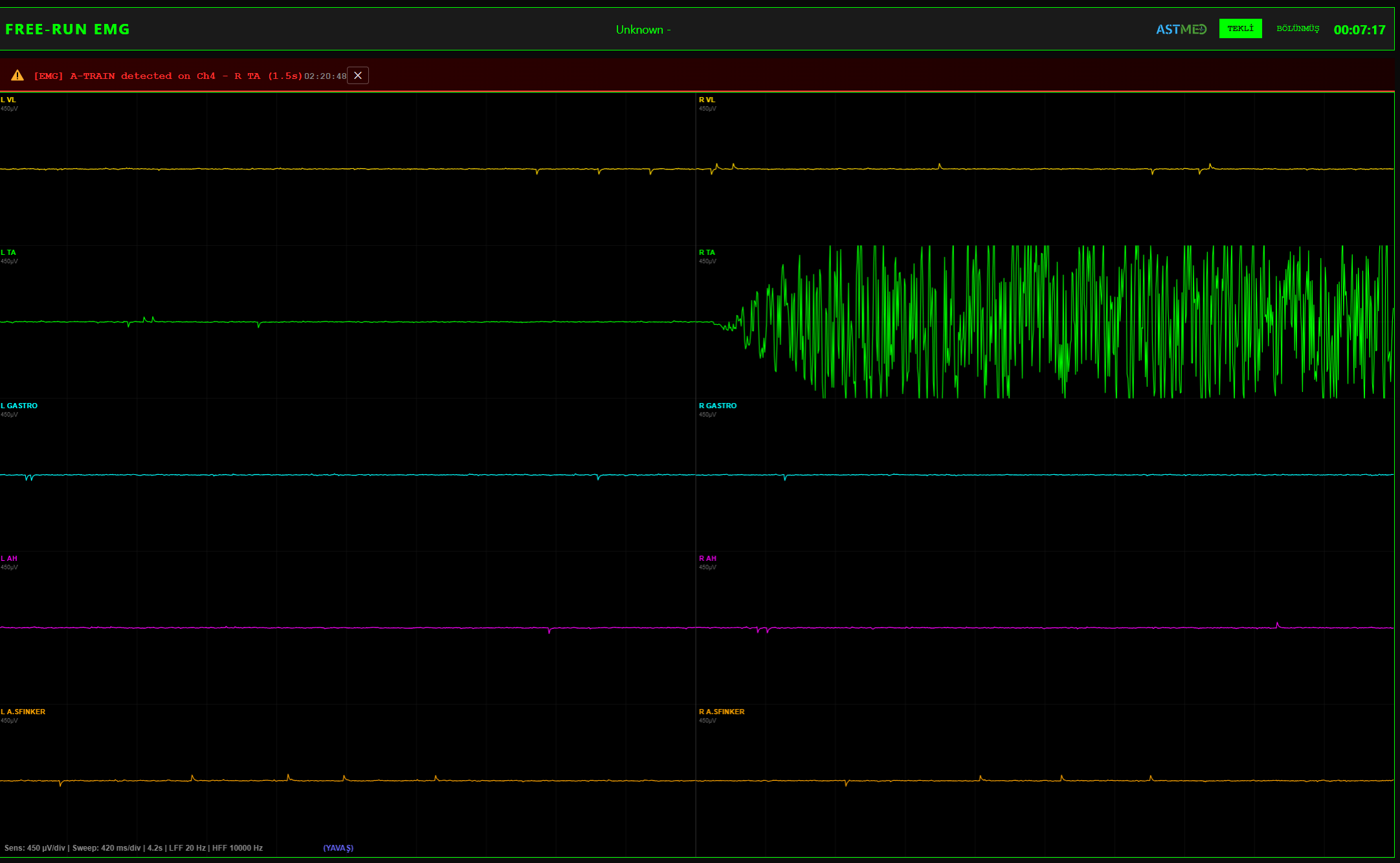 Free-run EMG — A-Train Yüksek Frekanslı Sürekli Deşarj Alarmı