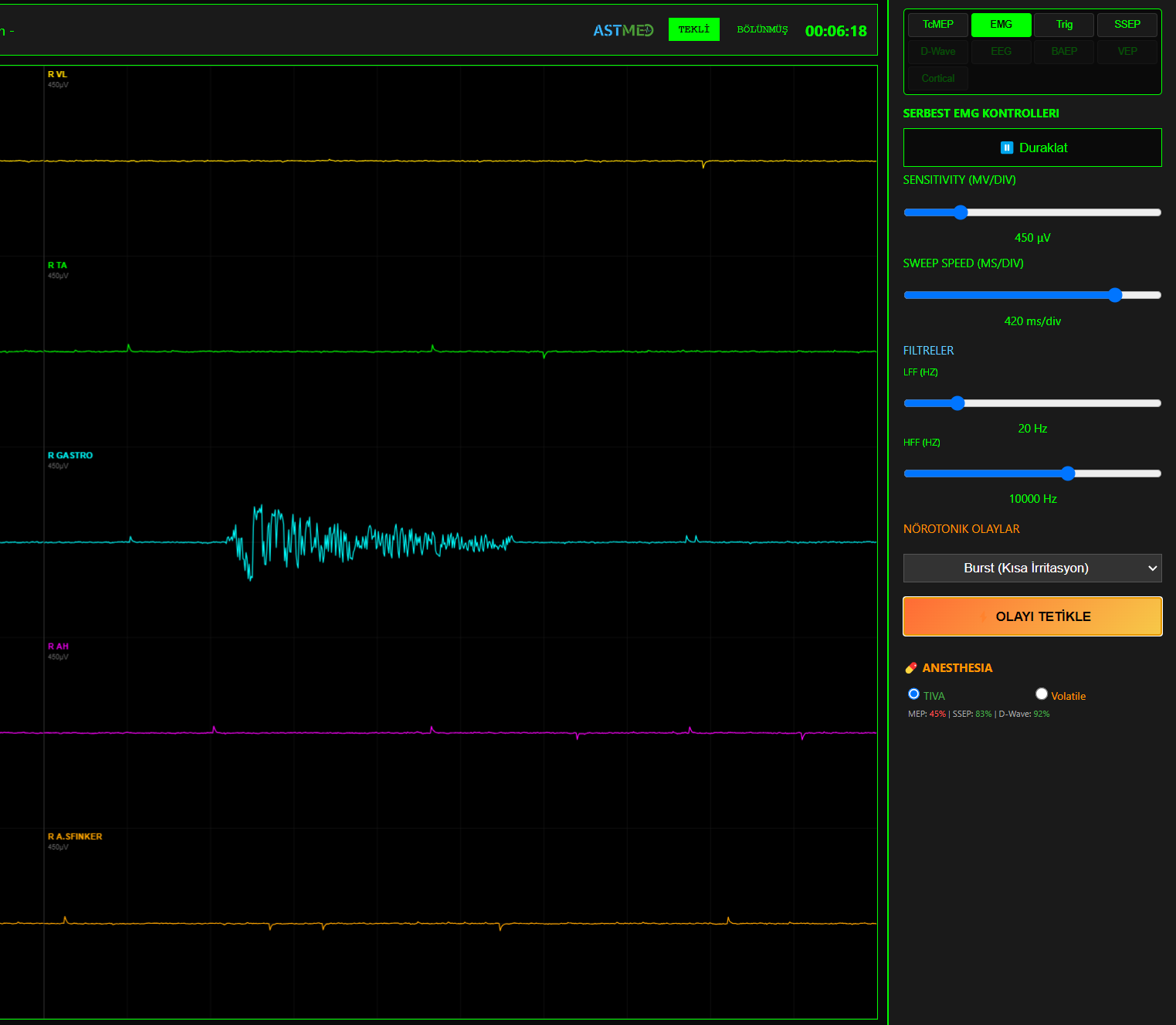 Free-run EMG — Burst Aktivitesi (Kısa İrritasyon Paterni)