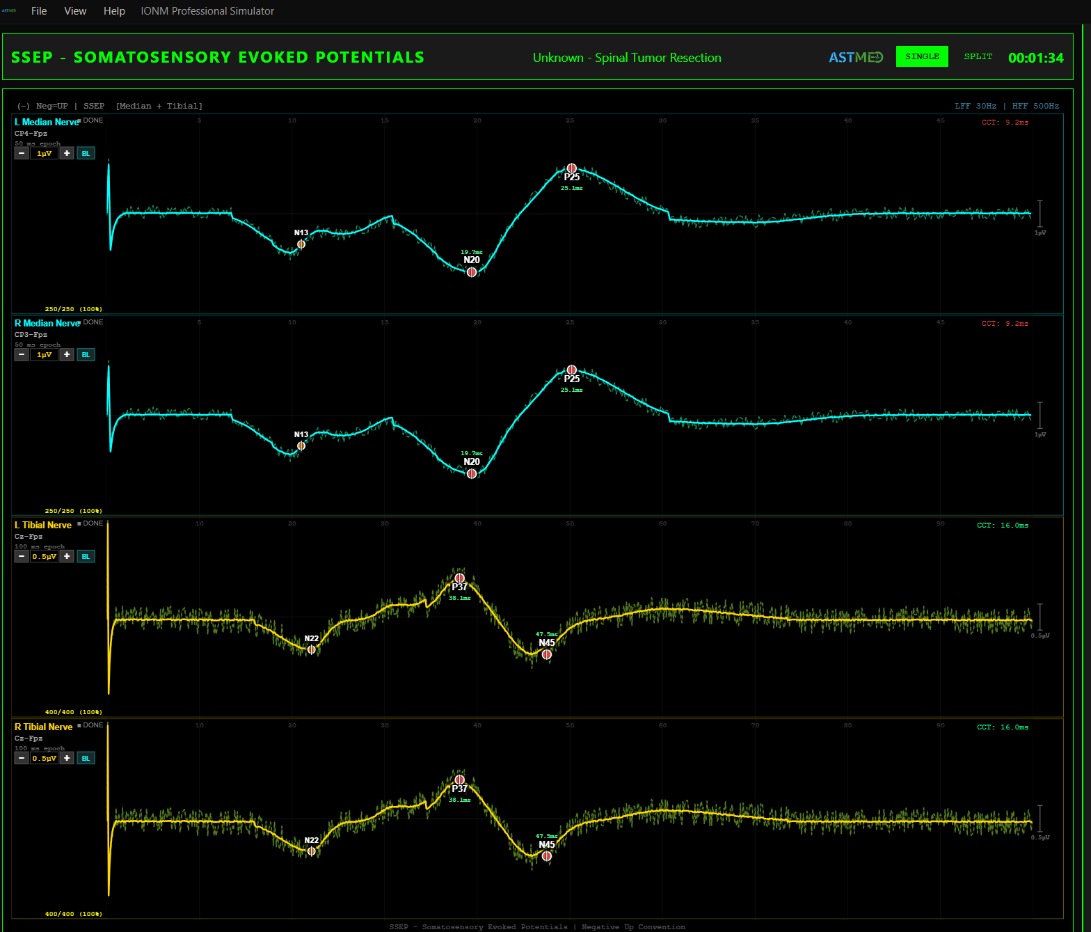 SSEP Somatosensoriyel Evoke Potansiyel — Median ve Tibial Sinir Dalga Formları
