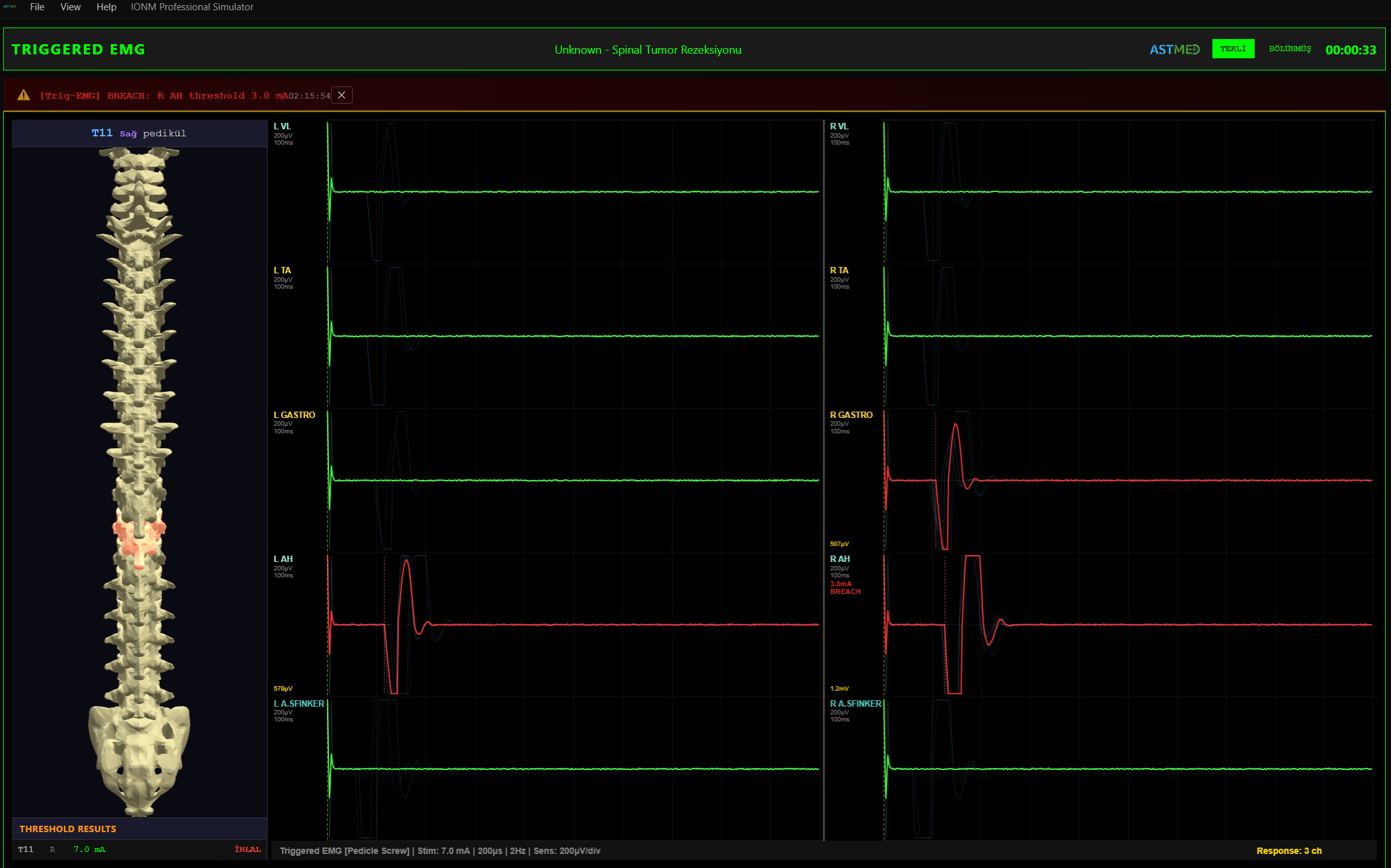 Pediküler Vida Testi — 3D Spine Modeli ile Eşik Analizi