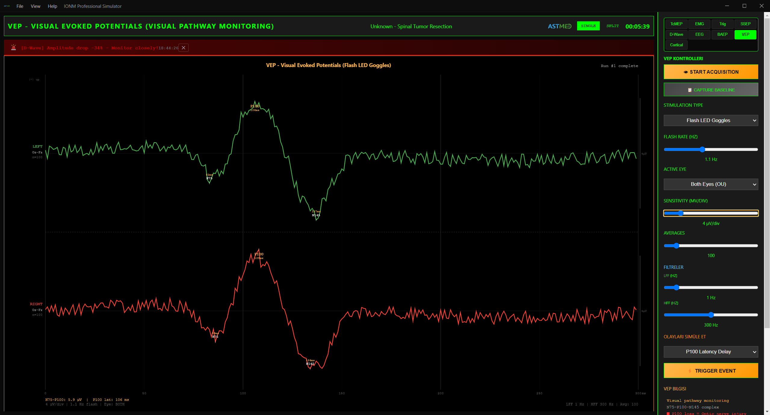 VEP Görsel Evoke Potansiyel Dalga Formu