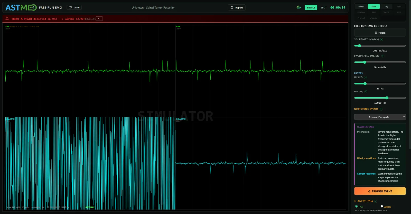 Free-run EMG, A-Train Yüksek Frekanslı Sürekli Deşarj Alarmı