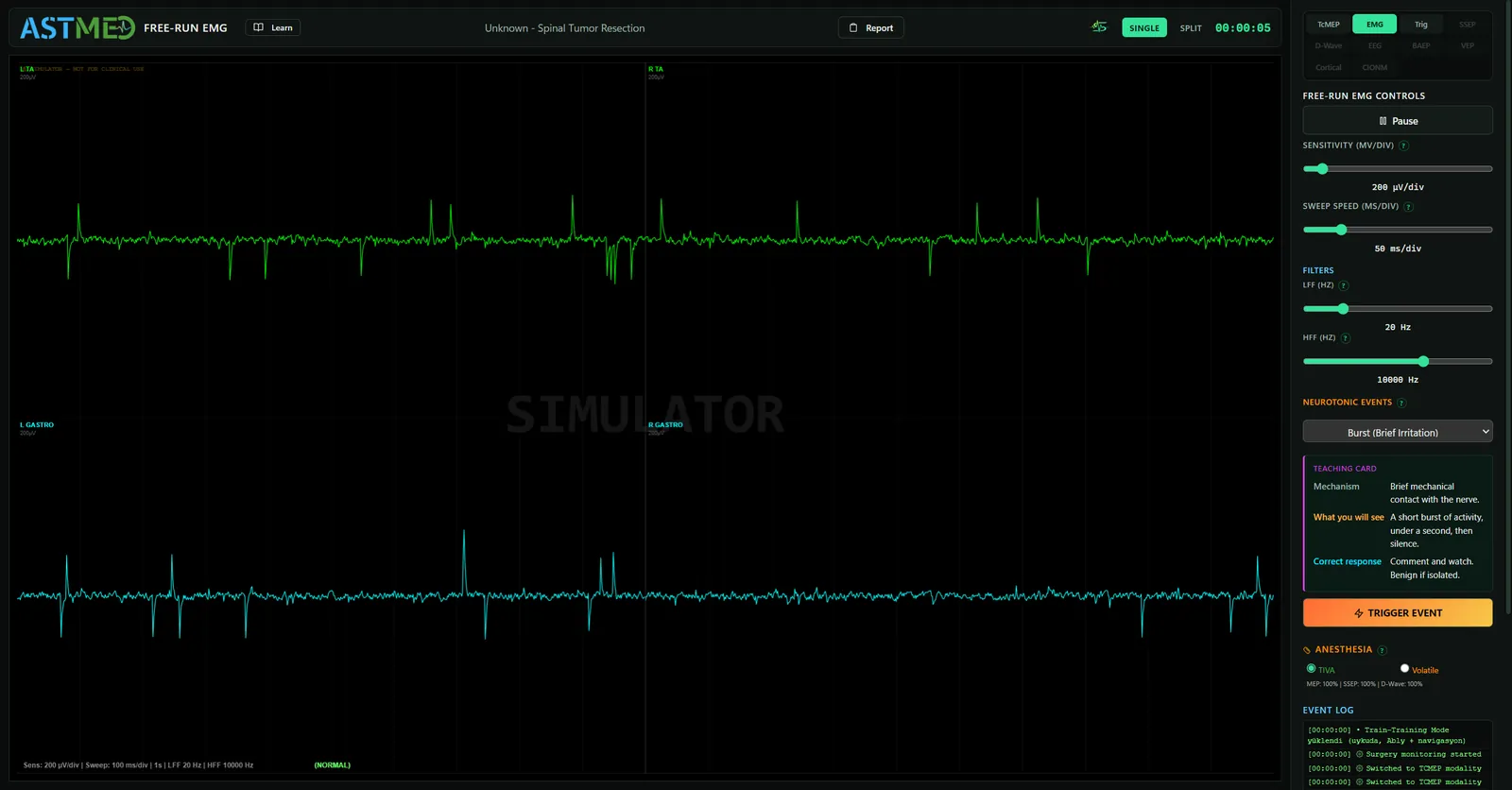 Free-run EMG, Burst Aktivitesi (Kısa İrritasyon Paterni)
