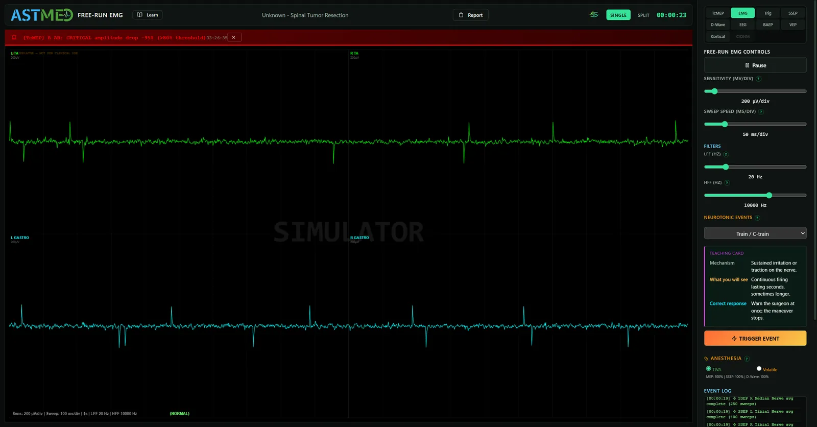 Free-run EMG, 10 Kanallı Spontan Aktivite İzleme Ekranı